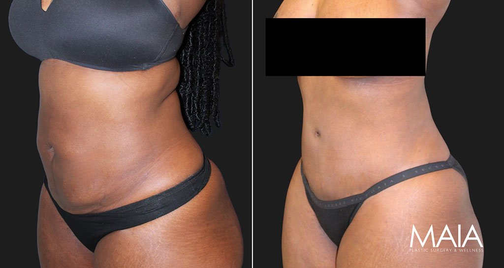 36 year-old before and 3 months post-op extended tummy tuck and liposuction of the flanks and abdomen
