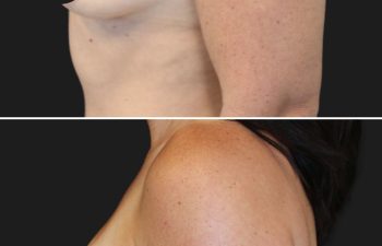 36 year-old before and 6 months after breast augmentation | Implant Size: 300cc moderate
