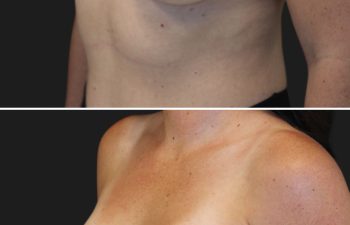 36 year-old before and 6 months after breast augmentation | Implant Size: 300cc moderate