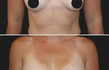 36 year-old before and 6 months after breast augmentation | Implant Size: 300cc moderate
