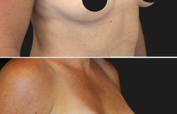 36 year-old before and 6 months after breast augmentation | Implant Size: 300cc moderate