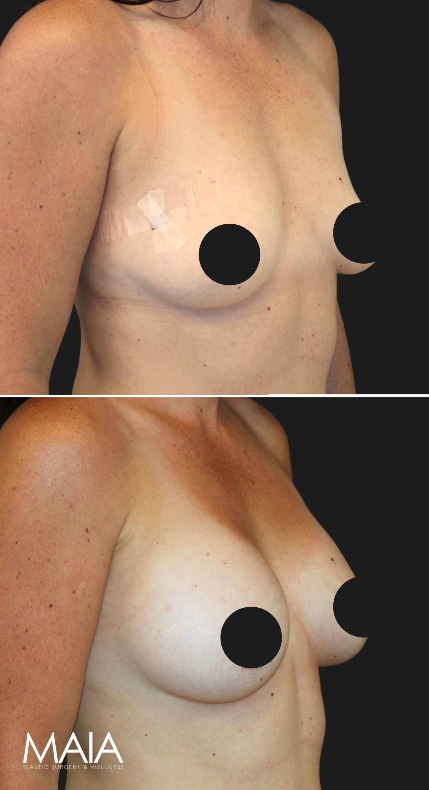 36 year-old before and 6 months after breast augmentation | Implant Size: 300cc moderate