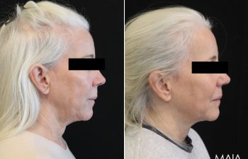 61 year-old patient before and 6 sessions after Clear + Brilliant to the face and neck