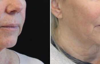 61 year-old patient before and 6 sessions after Clear + Brilliant to the face and neck