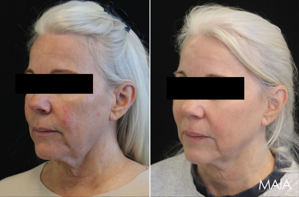 61 year-old patient before and 6 sessions after Clear + Brilliant to the face and neck