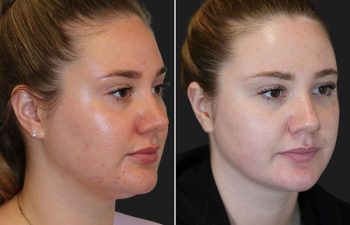 26 year-old patient before and 7 months after neck liposuction with Dr. Munique Maia in Tysons Corner, Virginia