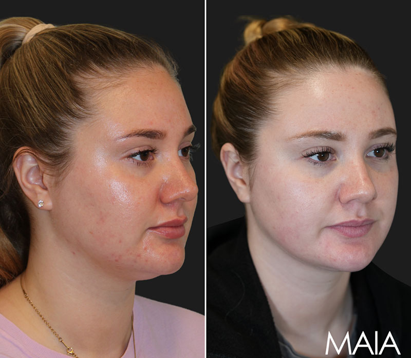 26 year-old patient before and 7 months after neck liposuction with Dr. Munique Maia in Tysons Corner, Virginia