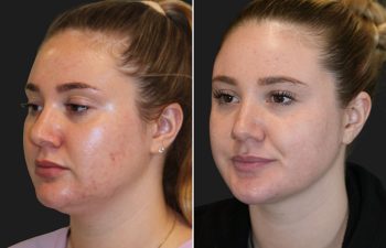 26 year-old patient before and 7 months after neck liposuction with Dr. Munique Maia in Tysons Corner, Virginia