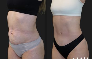 34 year old before and 3 months after abdominoplasty