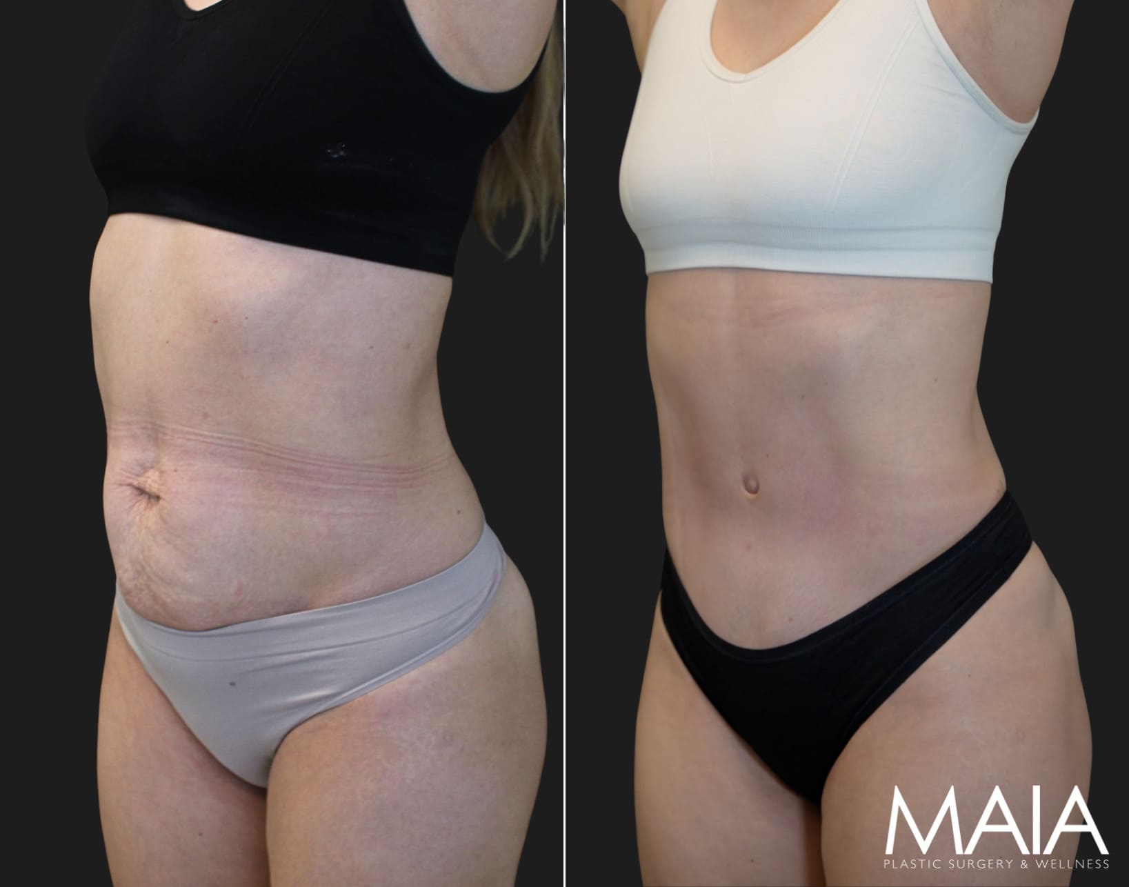 34 year old before and 3 months after abdominoplasty