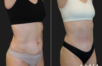 34 year old before and 3 months after abdominoplasty