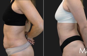34 year old before and 3 months after abdominoplasty