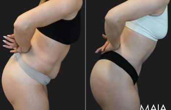 34 year old before and 3 months after abdominoplasty