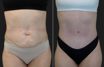 34 year old before and 3 months after abdominoplasty
