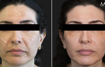 44 year-old patient before and 1 month after HALO and 3 sessions of Microneedling