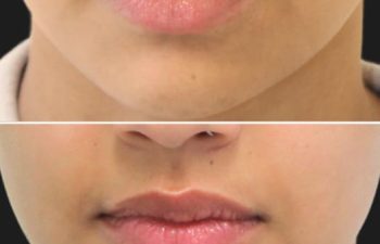 27 year-old before and 2 weeks and 3 days after Botox