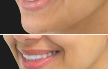 27 year-old before and 2 weeks and 3 days after Botox