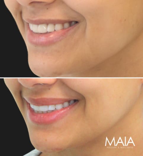 27 year-old before and 2 weeks and 3 days after Botox