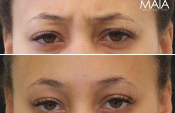 27 year-old before and 2 weeks and 3 days after Botox