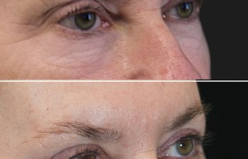 Before and 3 months after upper eyelid lift lower blepharoplasty mini brow lift and TCA peel