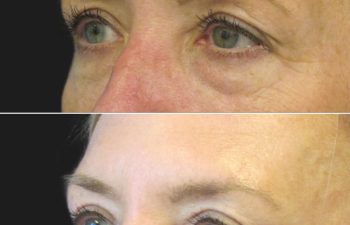 Before and 3 months after upper eyelid lift, lower blepharoplasty, mini brow lift, and TCA peel