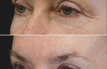 Before and 3 months after upper eyelid lift lower blepharoplasty mini brow lift and TCA peel