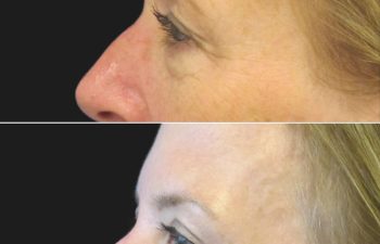 Before and 3 months after upper eyelid lift, lower blepharoplasty, mini brow lift, and TCA peel