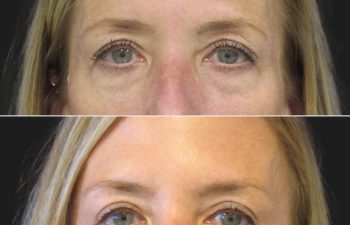 Before and 3 months after upper eyelid lift, lower blepharoplasty, mini brow lift, and TCA peel