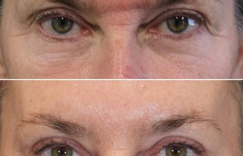 Before and 3 months after upper eyelid lift lower blepharoplasty mini brow lift and TCA peel
