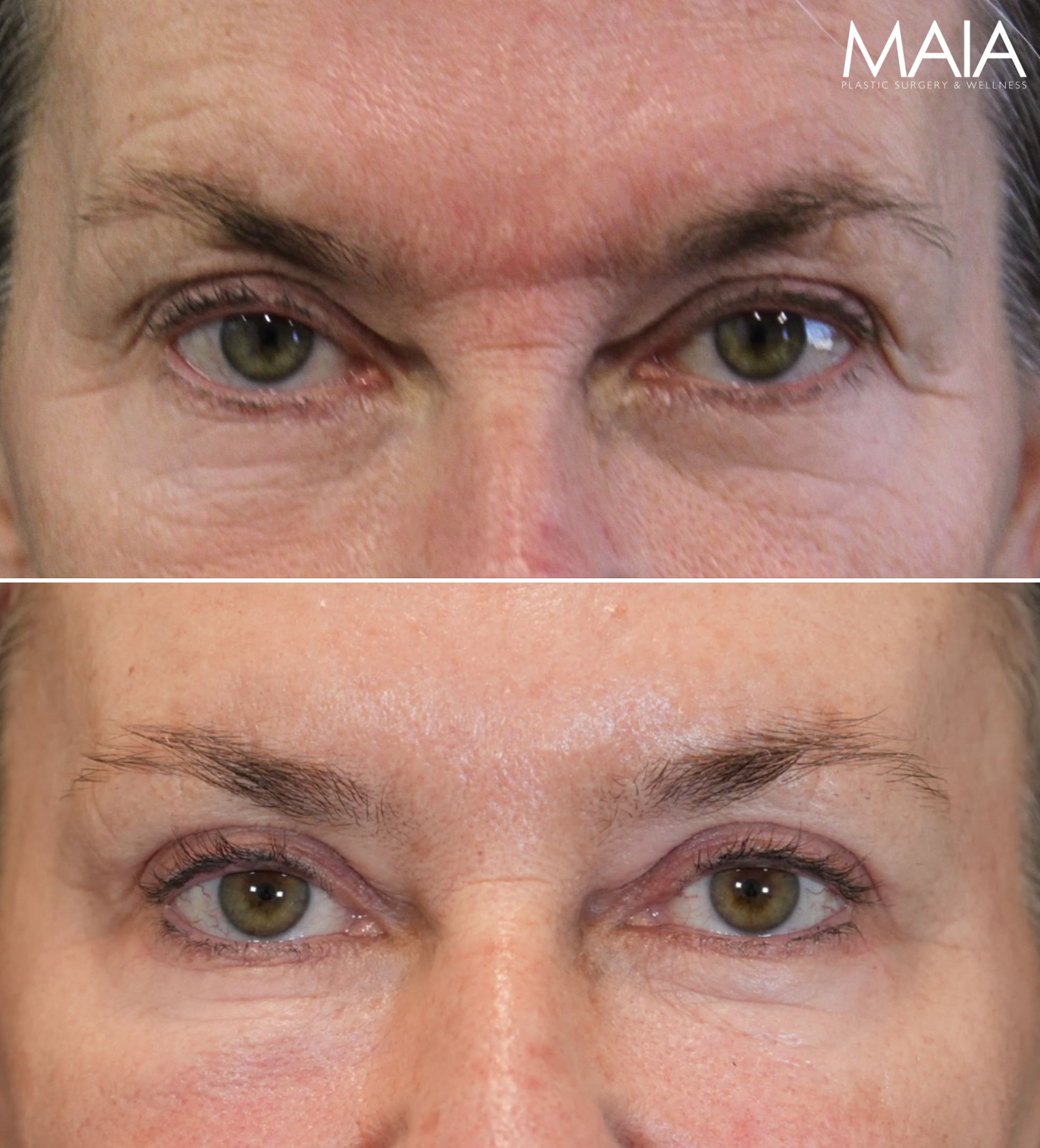 Before and 3 months after upper eyelid lift lower blepharoplasty mini brow lift and TCA peel