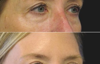 Before and 3 months after upper eyelid lift, lower blepharoplasty, mini brow lift, and TCA peel
