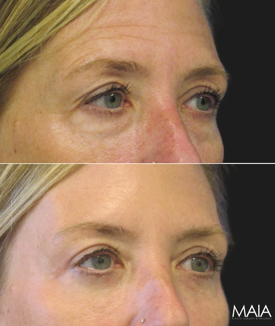 Before and 3 months after upper eyelid lift, lower blepharoplasty, mini brow lift, and TCA peel