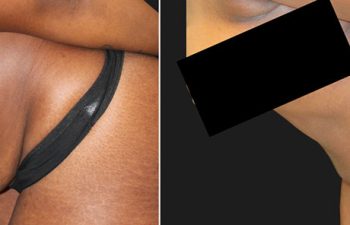 36 year-old before and 3 months post-op extended tummy tuck and liposuction of the flanks and abdomen