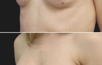 34 year-old before and 1 year and 2 months after breast augmentation | Implant Size: 275cc moderate