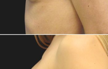 34 year-old before and 1 year and 2 months after breast augmentation | Implant Size: 275cc moderate