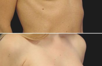 34 year-old before and 1 year and 2 months after breast augmentation | Implant Size: 275cc moderate