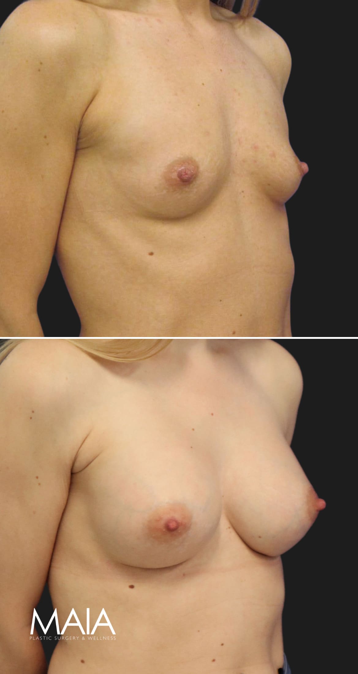 34 year-old before and 1 year and 2 months after breast augmentation | Implant Size: 275cc moderate