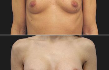 34 year-old before and 1 year and 2 months after breast augmentation | Implant Size: 275cc moderate