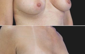 44 year-old before and 6.5 months after breast augmentation | Implant Size: 415cc Moderate