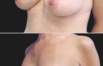 44 year-old before and 6.5 months after breast augmentation | Implant Size: 415cc Moderate