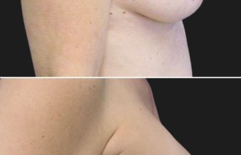 44 year-old before and 6.5 months after breast augmentation | Implant Size: 415cc Moderate