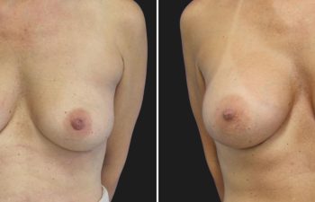 44 year-old before and 6.5 months after breast augmentation | Implant Size: 415cc Moderate