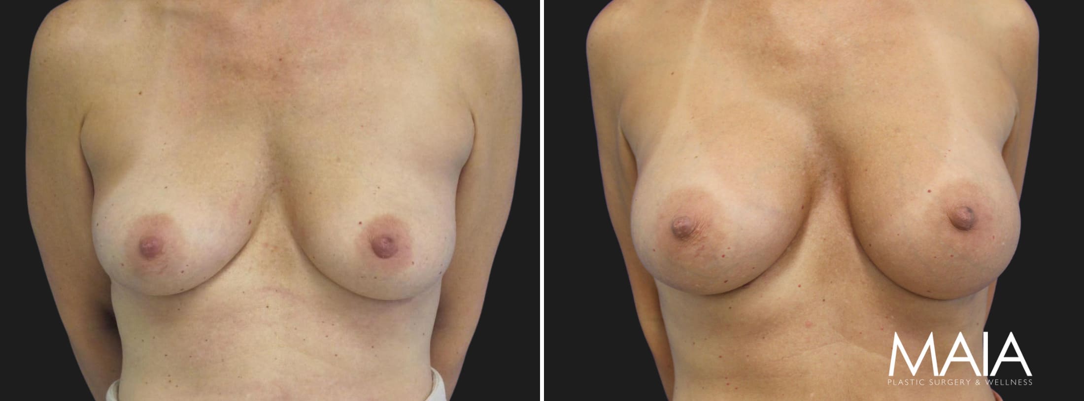 44 year-old before and 6.5 months after breast augmentation | Implant Size: 415cc Moderate