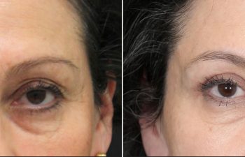 62 year old female before and 5 weeks after eyelid lift