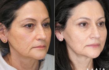 62 year old female before and 5 weeks after eyelid lift