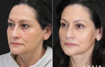 62 year old female before and 5 weeks after eyelid lift