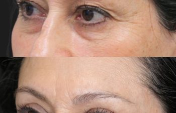 62 year old female before and 5 weeks after eyelid lift