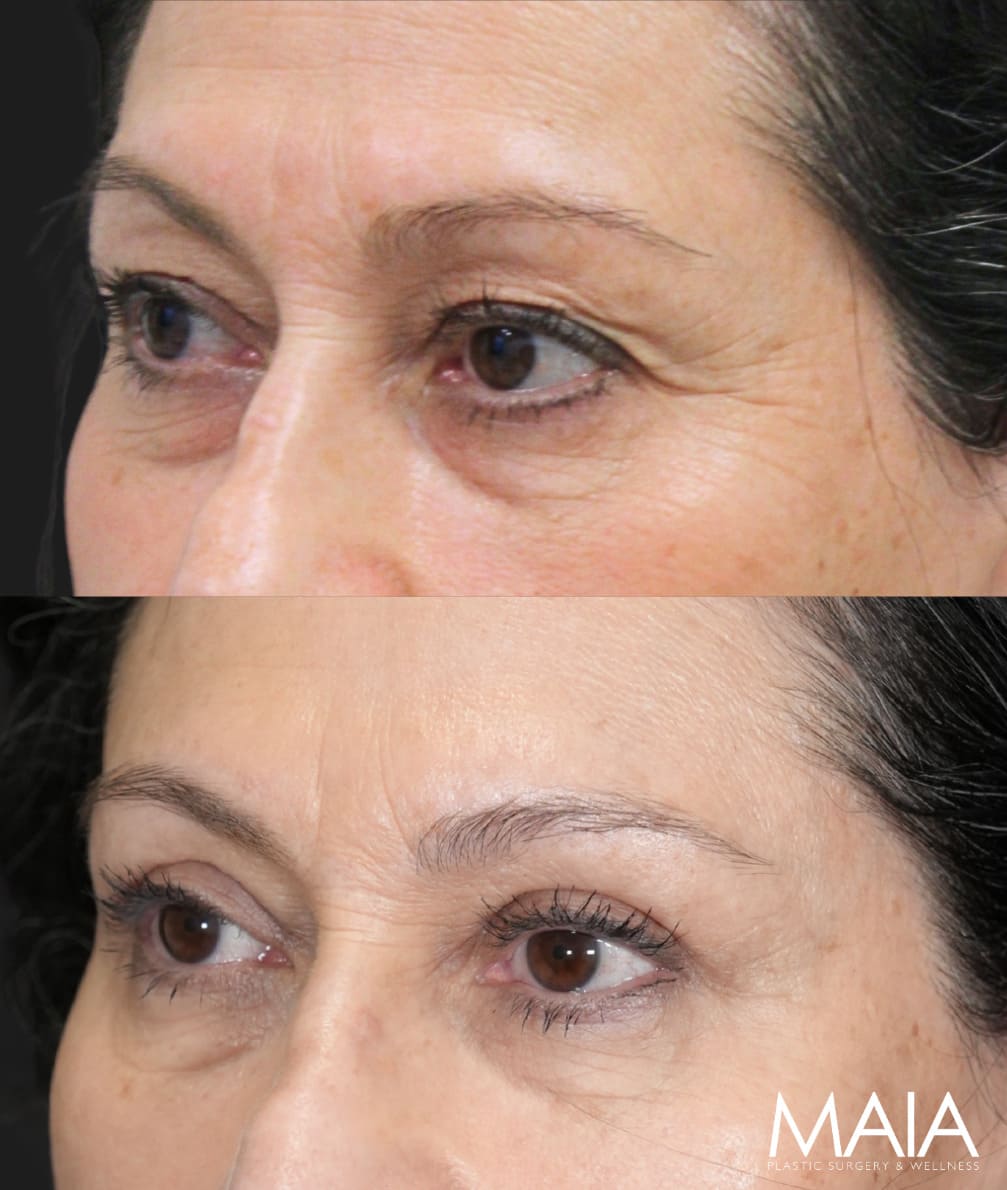 62 year old female before and 5 weeks after eyelid lift