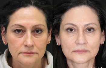 62 year old female before and 5 weeks after eyelid lift