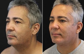 51 year-old male before and 2 months after comprehensive facial rejuvenation with Dr. Munique Maia in Tysons Corner, Virginia Healing In Progress, left oblique view